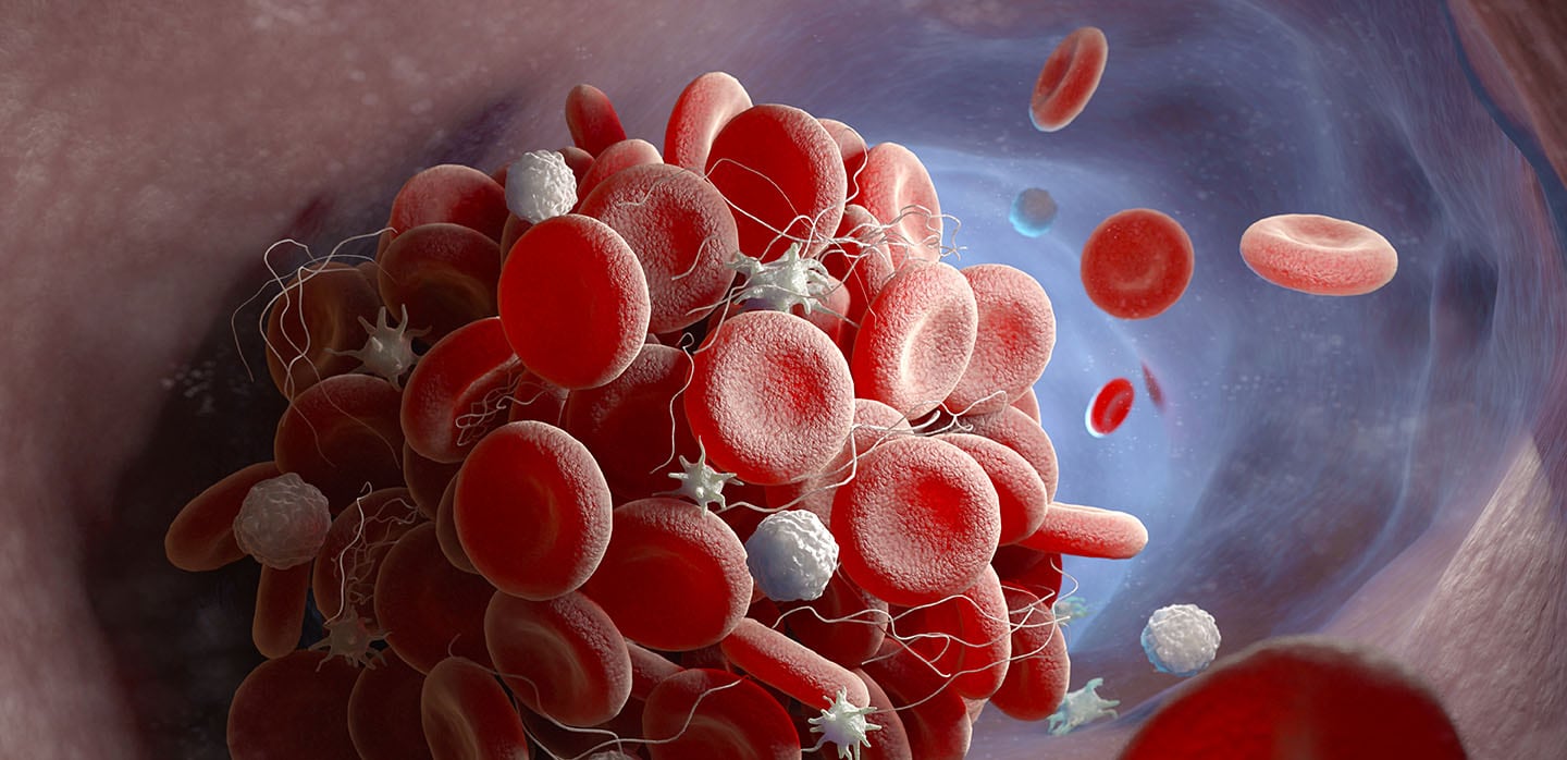 Does COVID-19 Cause Thrombosis and Pulmonary Embolisms?