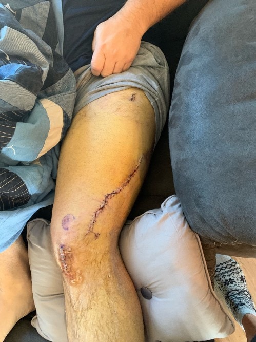 Leg surgery scar