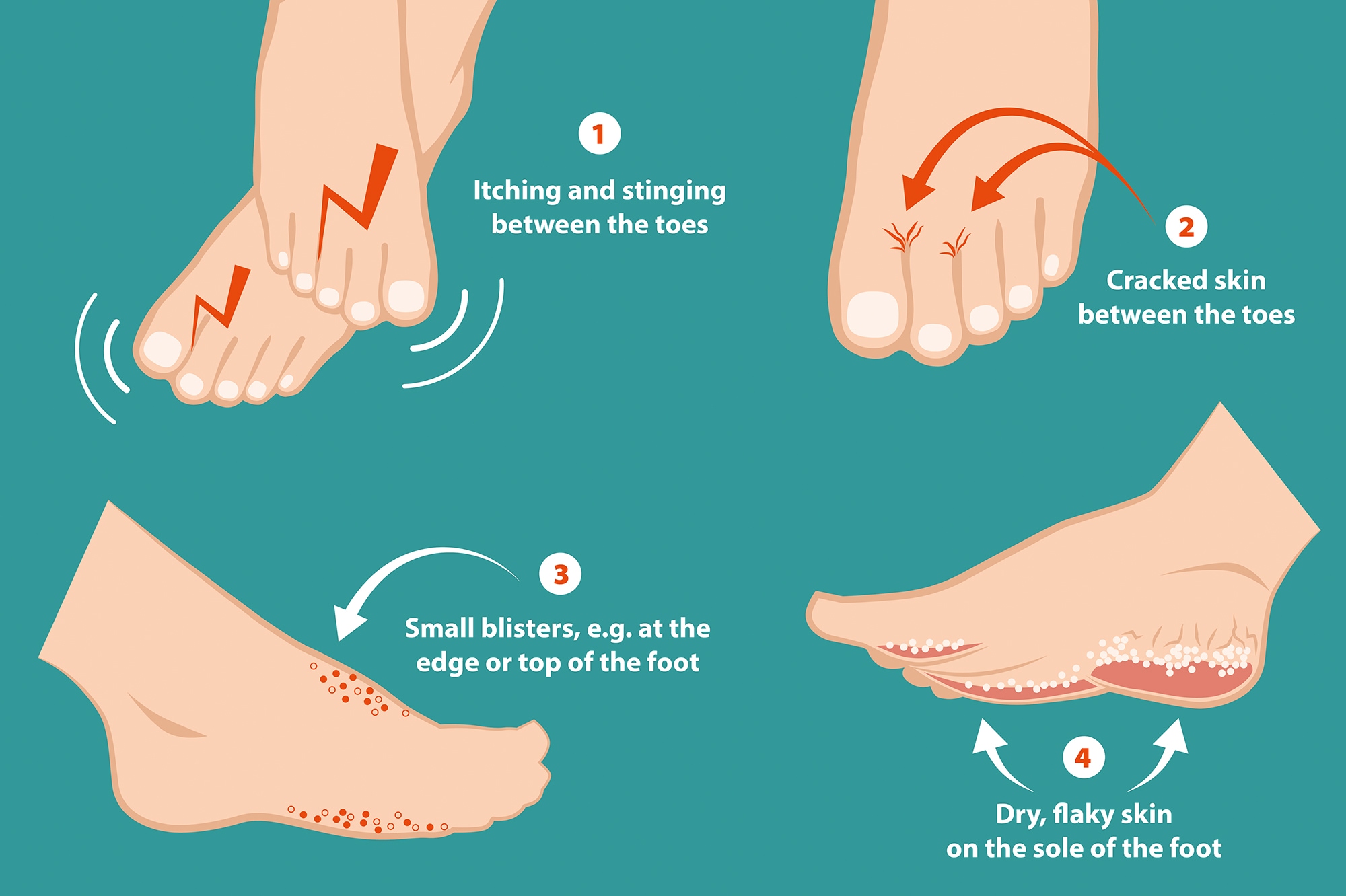 Treating Athletes Foot A Common Condition For Swimmers Bayer Global